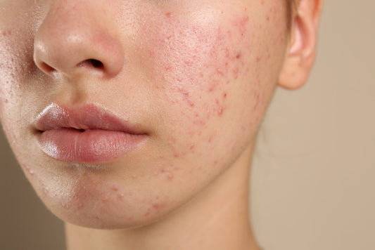 Acne – Allt du behöver veta & hur du behandlar acne på mindre än 4 veckor!